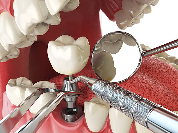 Best Emergency Dental Care for Broken or Chipped Teeth in Weston Mills, NY